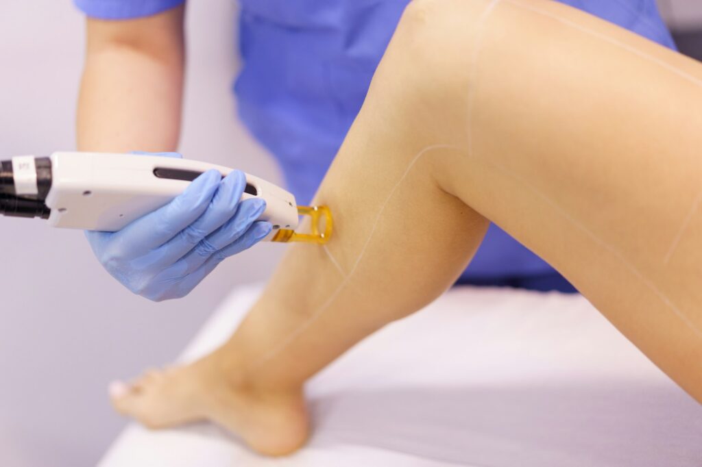 Woman receiving legs laser hair removal at a beauty center